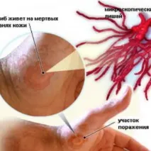 Як лікувати лишай у людини – огляд найефективніших способів лікування лікувати