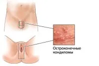 Як гострі кондиломи лікувати народним методом Лікування хвороб та недуг народними засобами методом