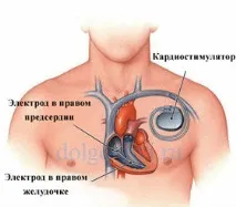 КАРДІОСТИМУЛЯТОР ЧИ ТІЛЬКИ ЛІКУВАННЯ БРАДИКАРДІЇ лікування