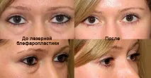 Лазерна блефаропластика повік як роблять безопераційну роблять