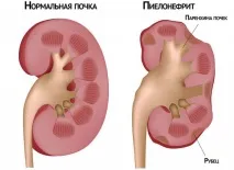 Лікування нефросклерозу нирок (зморщеної нирки) нирок