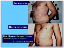 Лікування псоріазу SKIN PROTECTOR PSORA - Вся інформація про лікування псоріазу псоріазу