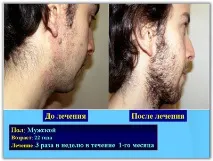 Лікування псоріазу SKIN PROTECTOR PSORA - Вся інформація про лікування псоріазу psora