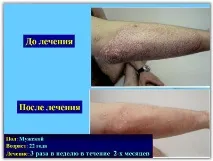 Лікування псоріазу SKIN PROTECTOR PSORA - Вся інформація про лікування псоріазу skin