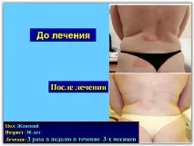 Лікування псоріазу SKIN PROTECTOR PSORA - Вся інформація про лікування псоріазу psora