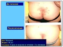 Лікування псоріазу SKIN PROTECTOR PSORA - Вся інформація про лікування псоріазу лікування