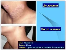 Лікування псоріазу SKIN PROTECTOR PSORA - Вся інформація про лікування псоріазу protector