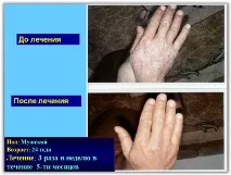 Лікування псоріазу SKIN PROTECTOR PSORA - Вся інформація про лікування псоріазу псоріазу