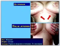 Лікування псоріазу SKIN PROTECTOR PSORA - Вся інформація про лікування псоріазу інформація
