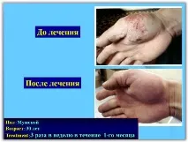 Лікування псоріазу SKIN PROTECTOR PSORA - Вся інформація про лікування псоріазу інформація