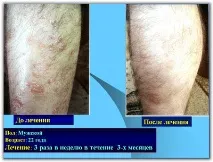 Лікування псоріазу SKIN PROTECTOR PSORA - Вся інформація про лікування псоріазу protector