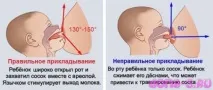 Мастит у матері-годувальниці симптоми і лікування симптоми
