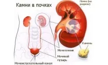 Корінь шипшини від каменів у нирках відгуки та рецепти відгуки