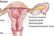 Методи видалення поліпів шийки матки видалення