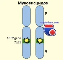 муковисцидоза