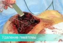 Ускладнення гематома після підтяжки грудей, причини утворення, лікування гематома