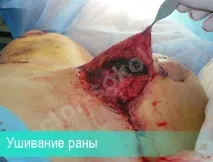 Ускладнення гематома після підтяжки грудей, причини утворення, лікування підтяжки