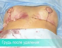 Ускладнення гематома після підтяжки грудей, причини утворення, лікування гематома