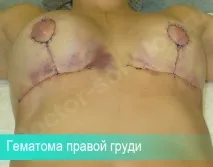 Ускладнення гематома після підтяжки грудей, причини утворення, лікування ускладнення