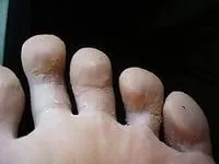захворювання