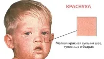 Краснуха - причини, симптоми, діагностика та лікування краснуха