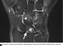 КТ і МРТ променево-зап’ясткового суглоба та кисті, Друга думка суглоба