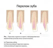 Перелом кореня зуба симптоми та лікування симптоми