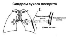 Плеврит легень симптоми та лікування у літніх симптоми