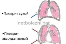 Плеврит легень симптоми та лікування у літніх плеврит