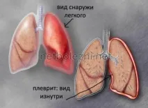 Плеврит легень симптоми та лікування у літніх плеврит