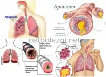 Плеврит легень симптоми та лікування у літніх плеврит