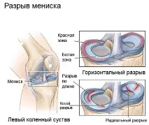 Пошкодження меніска колінного суглоба лікування, симптоми суглоба