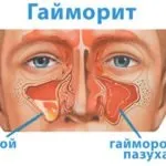 Ознаки гаймориту у дітей ознаки