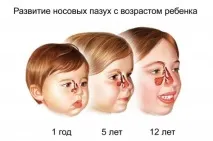 Ознаки гаймориту у дітей дітей