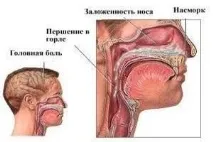 Ознаки гаймориту у дітей ознаки