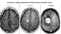 Рак мозку симптоми, причини, діагностика, лікування, прогноз причини