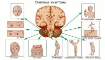 Рак мозку симптоми, причини, діагностика, лікування, прогноз симптоми