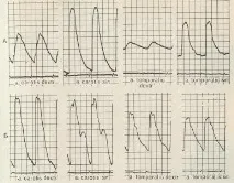 Sfigmografie - Metode de cercetare funcțională - Angiologie clinică - totul despre sănătatea inimii