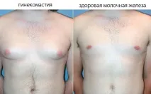 Лікування гінекомастії - Медичний портал EUROLAB медичний