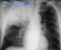 Tuberculomul și silicoza pulmonară