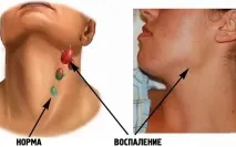 Збільшено лімфовузли підщелепні причини захворювання