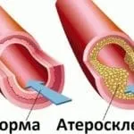 Вітаміни при гіпертонії - що допомагає найкраще найкраще
