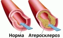Вітаміни при гіпертонії - що допомагає найкраще організму