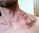 Лімфома шкіри - причини, симптоми, діагностика та лікування лімфома