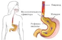 Життя після видалення жовчного міхура плюси та мінуси, важливі поради видалення