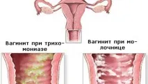 Свербіж у піхву причини, ніж лікувати печіння у піхву причини