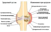 Артроз суглобів - причини, симптоми, розвиток, профілактика та лікування, Любимо Життя артроз