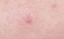 запалення