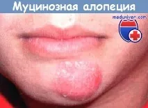 Фолікулярний муциноз фолікулярного