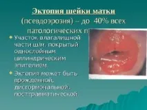 Флуомізин при ерозії схема прийому препарату, показання та протипоказання до прийому прийому